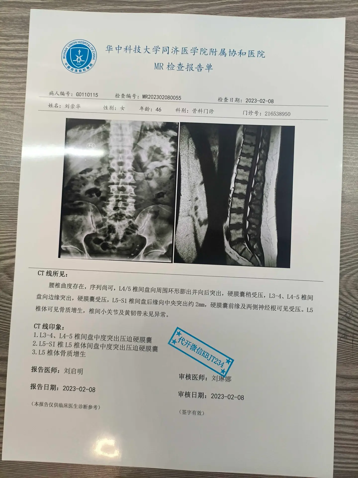 代开腰椎间盘突出报告 代开腰椎间盘突出检查报告